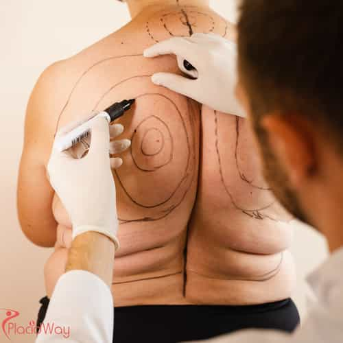 Liposuction for Men in Colombia: Abdominal Etching & Body Sculpting Trends